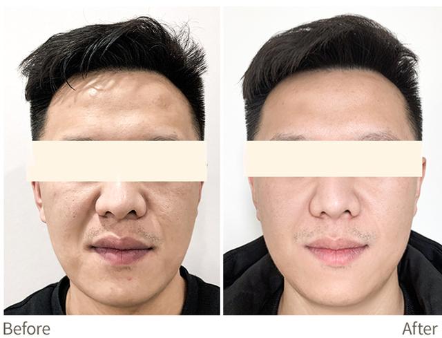 超声炮是什么美容项目多少钱一次，做超声炮多少钱？