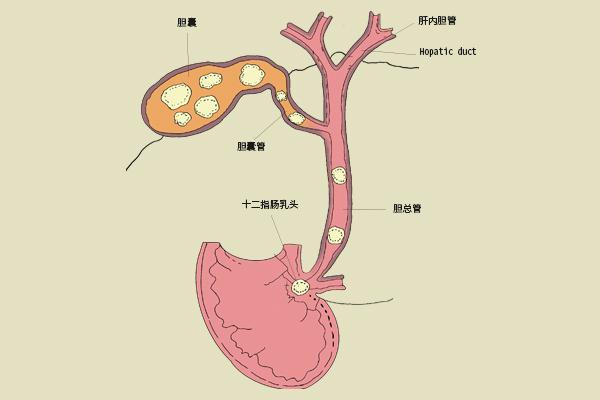 胆囊结石手术费用大概多少（胆囊炎胆囊结石做手术要多少钱）