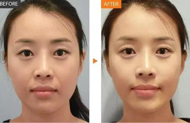 超声炮是什么美容项目多少钱一次，做超声炮多少钱？