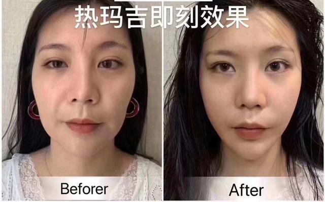 超声炮是什么美容项目多少钱一次，做超声炮多少钱？