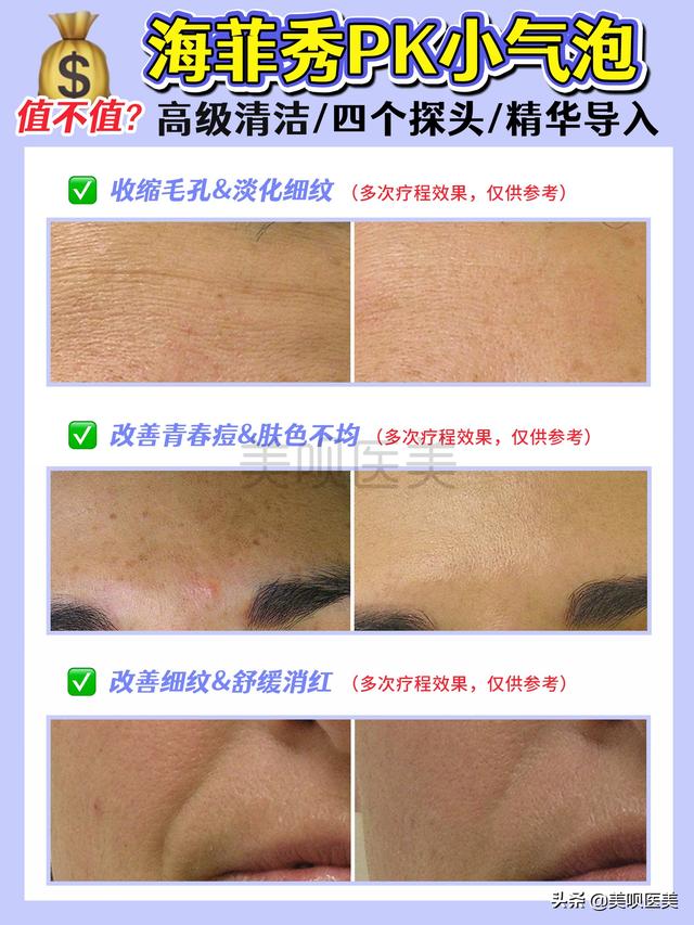 海菲秀是什么美容项目，海菲秀多长时间？